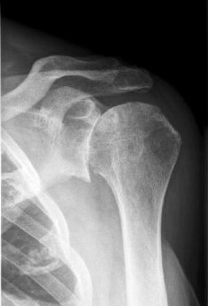 Osteoartrita articulației cotului